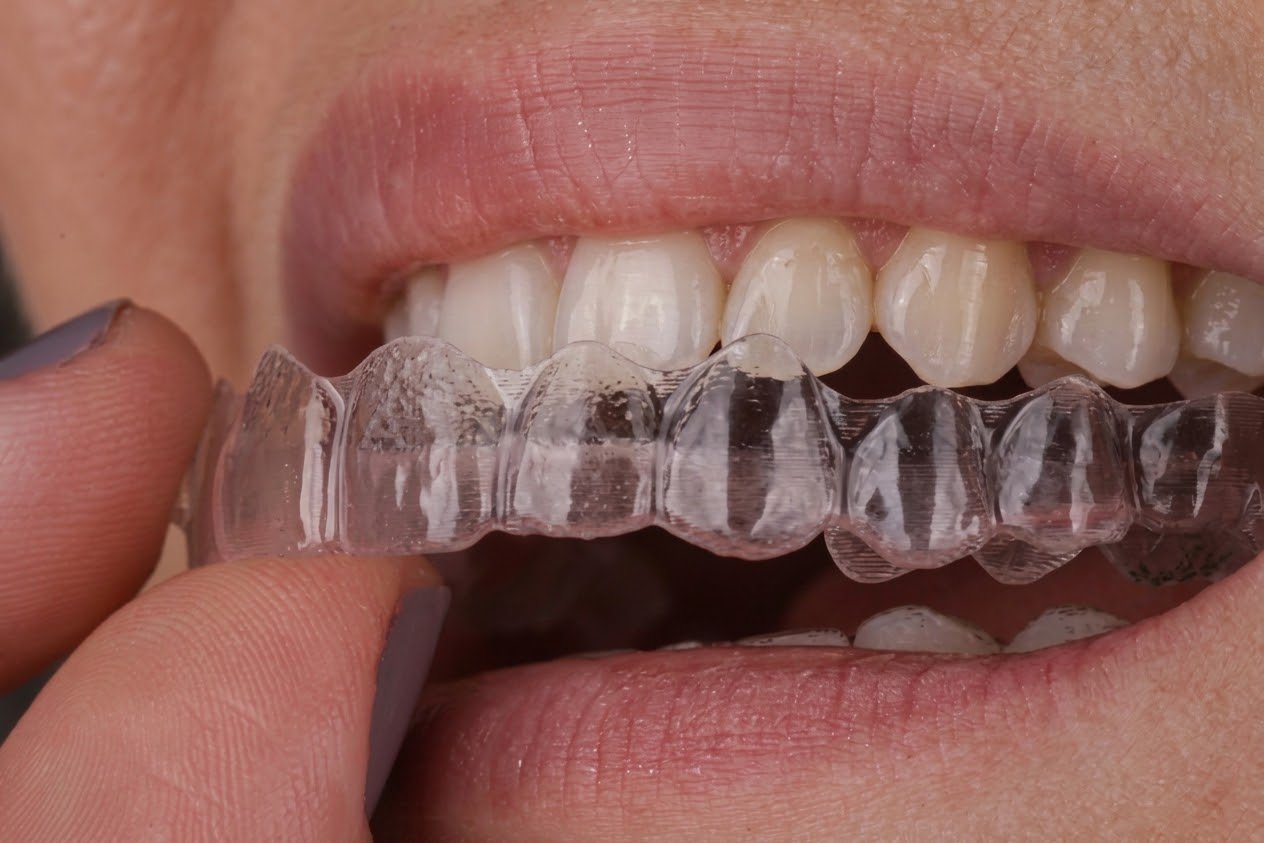 Alinhador transparente removível segurado próximo aos dentes superiores