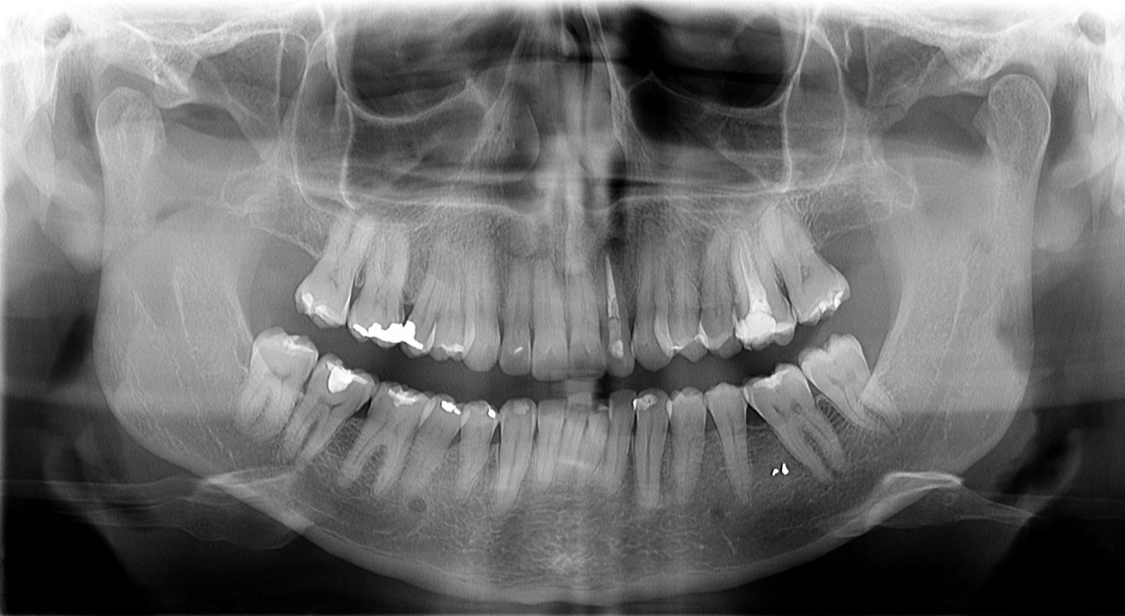 Radiografia panorâmica para diagnóstico ortodôntico